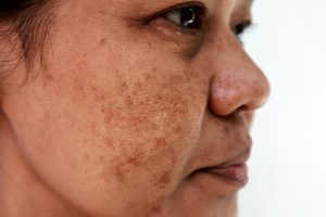 How Can I Reverse Melasma?